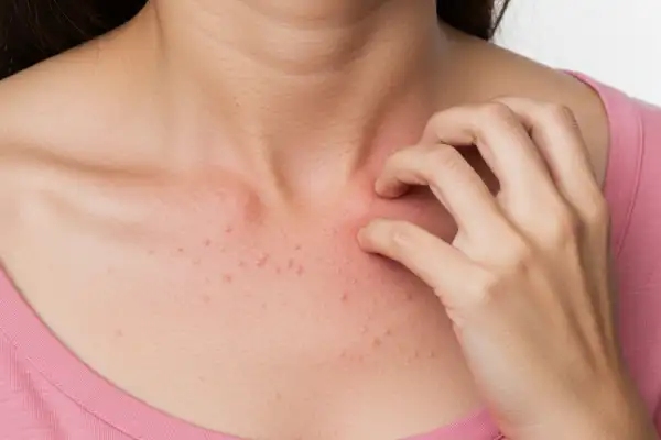 Eczema