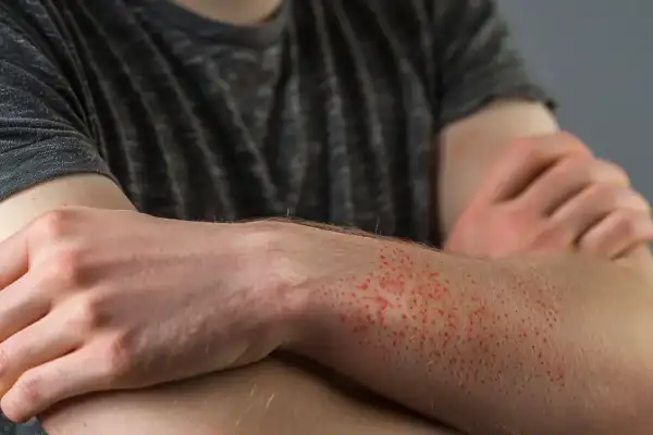 Mastocytosis