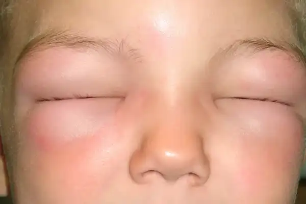 Angioedema