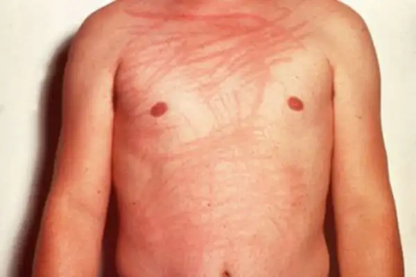 Dermatographism