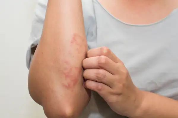 Eczema